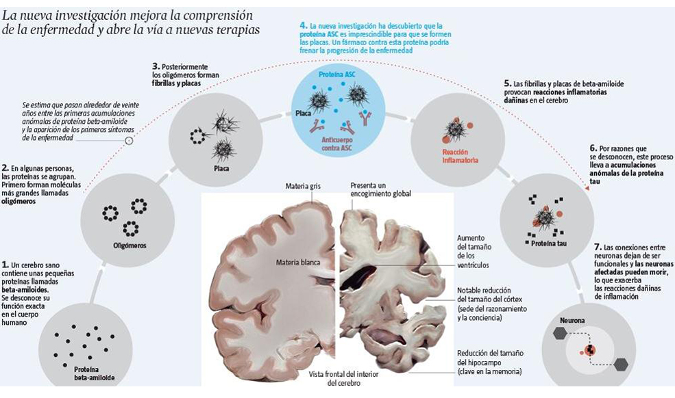 DESCUBIERTA UNA PROTEÍNA CLAVE EN EL ALZHEIMER